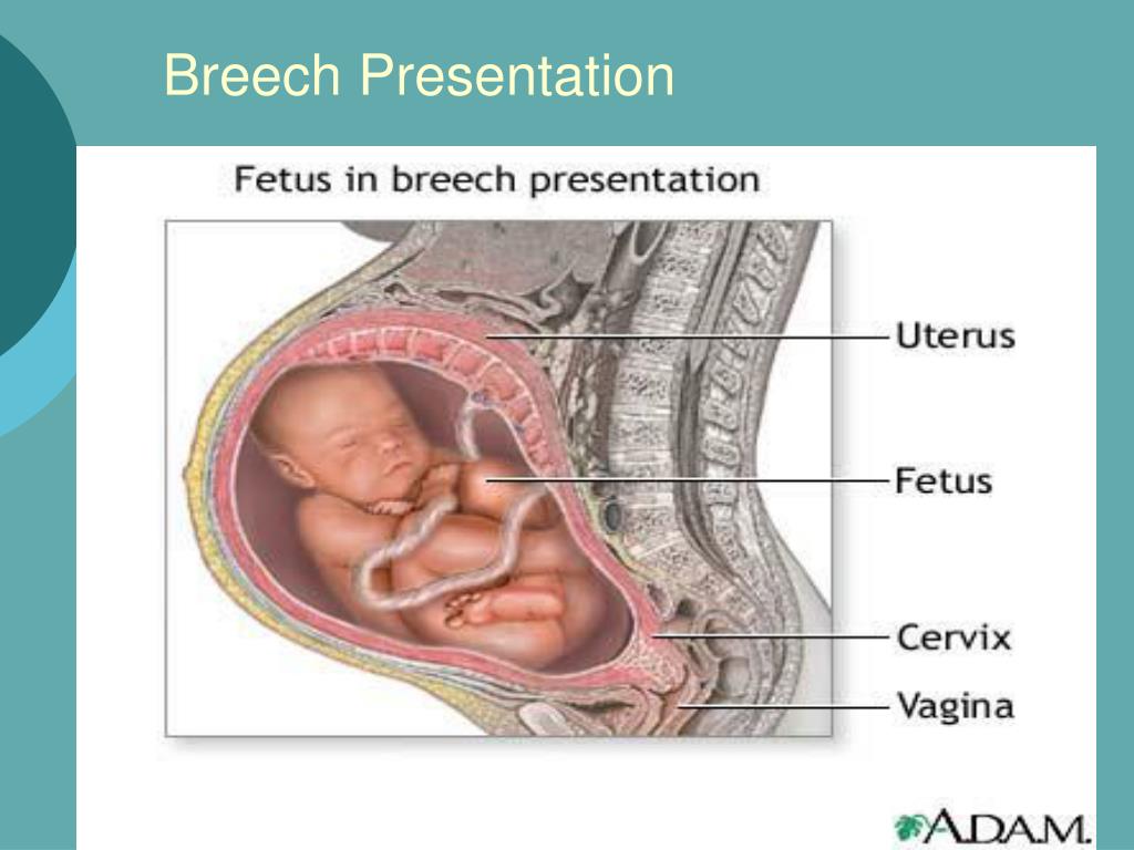 introduction of breech presentation