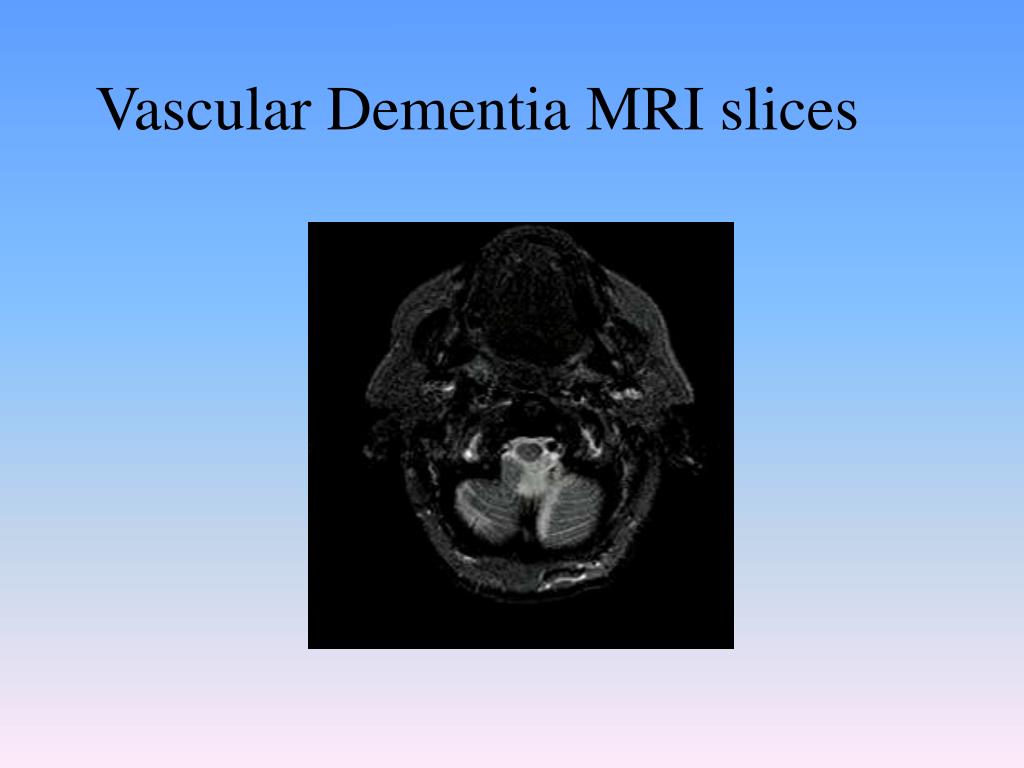 PPT - Dementia PowerPoint Presentation, free download - ID:246616