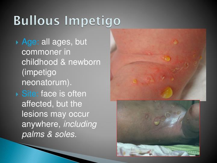 Ppt Bacterial Skin Infection Powerpoint Presentation Id250111