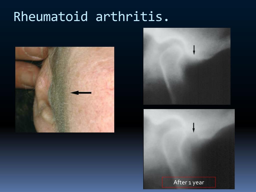 Tmj Arthritis