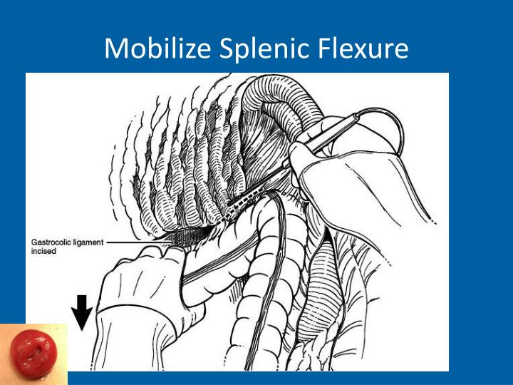 muscle spasms near the splenic flexture muscle spasms near the splenic flexture