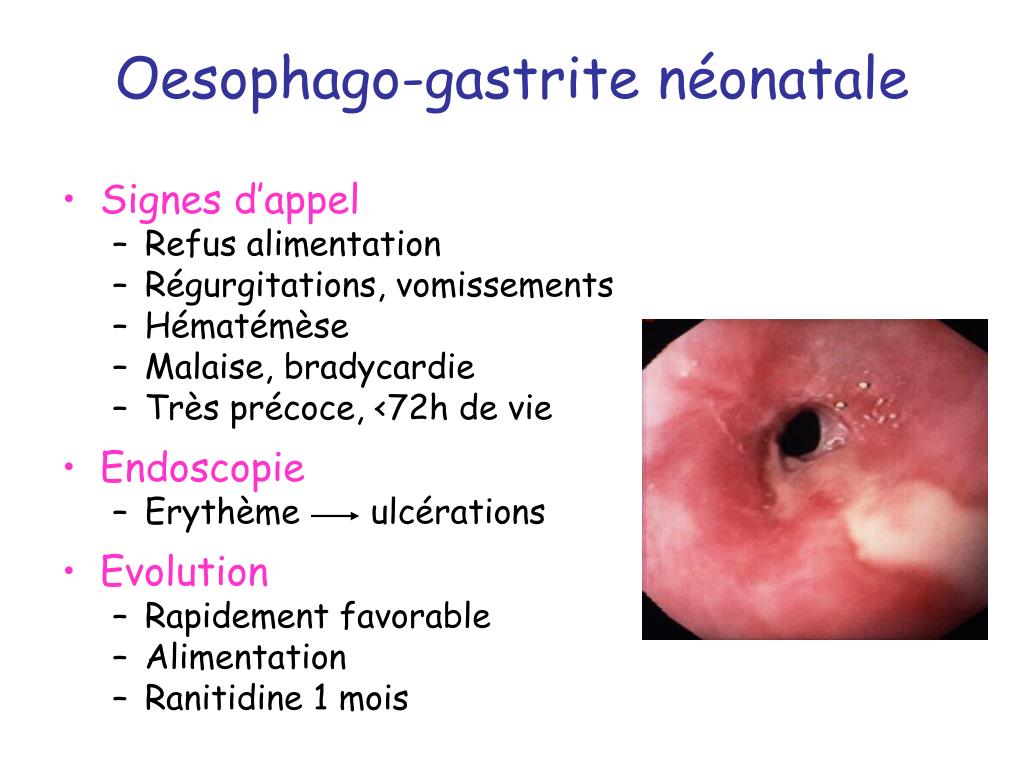 PPT - Hémorragies Digestives PowerPoint Presentation, free download - ID:258005