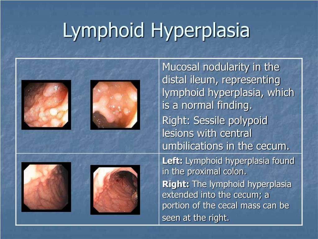 reactive lymphoid hyperplasia tonsils icd 10