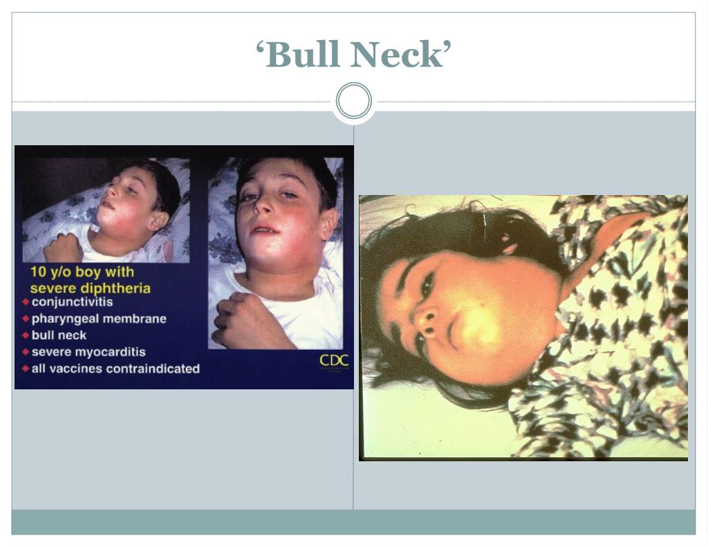 PPT Diphtheria PowerPoint Presentation Free Download ID 260231
