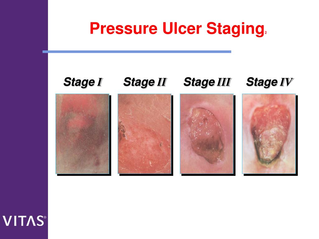 Pressure Ulcers What Are They Sore Skin Pressure Ulce - vrogue.co