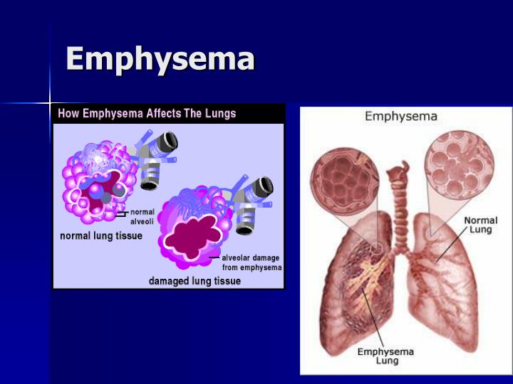 PPT - Medical Nutrition Therapy in Pulmonary Disease PowerPoint ...