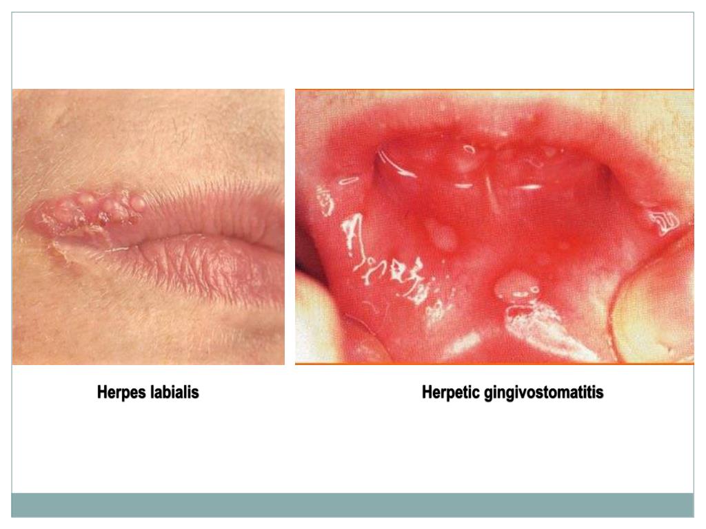 Herpes narbe geht nicht weg - 🧡 What is Herpes Simplex? (with pictures) .