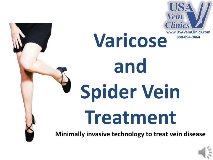 varicose and spider vein treatment minimally invasive technology to treat vein disease n.