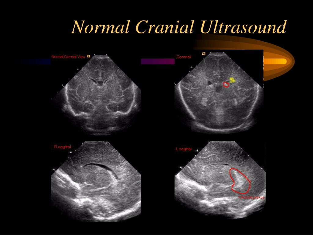 Cranial Ultrasound