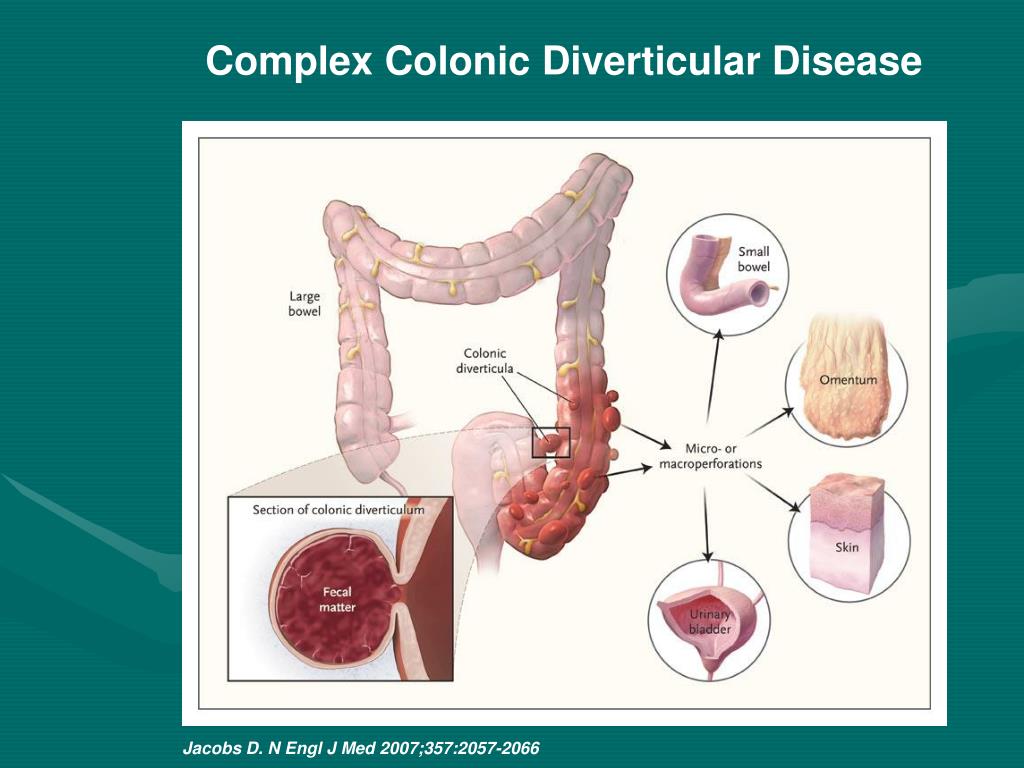 Complex Colonic Diverticular Disease.