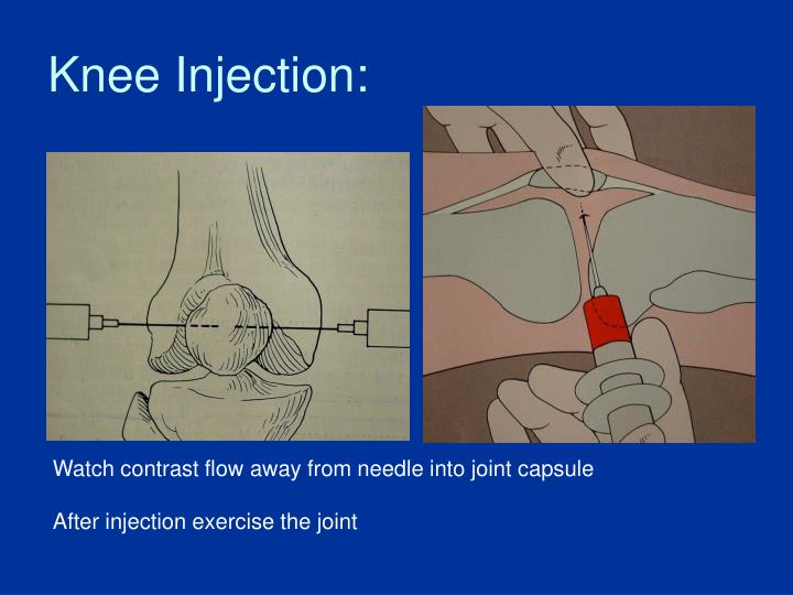 Tibia Meniscus Injection PPT - Basic Joint Injection “How to do it” PowerPoint Presentation - ID ...