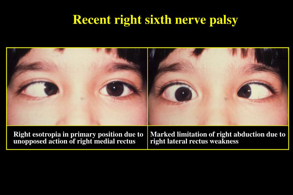 Prism Glasses For Sixth Nerve Palsy At Mary Wilber Blog