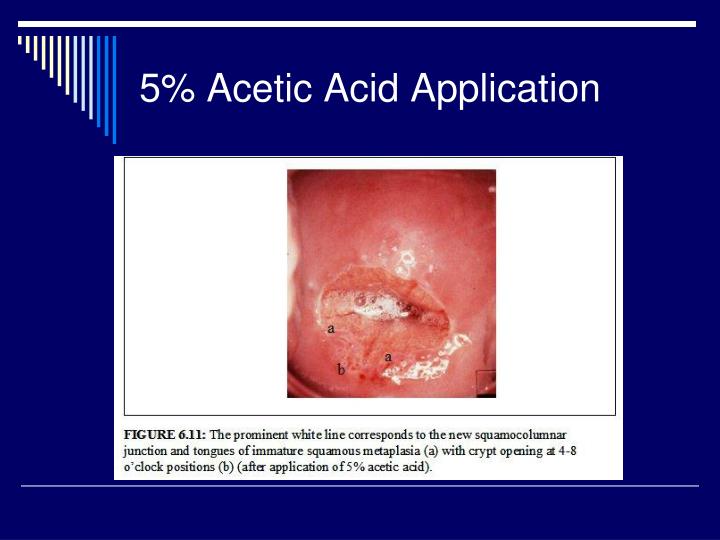 PPT Colposcopy PowerPoint Presentation ID 275680