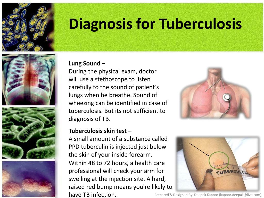 Negativo prueba de tuberculosis positiva fotos