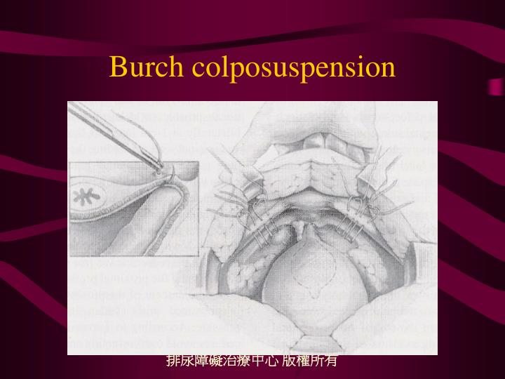 PPT Surgical Treatment of Stress Urinary Incontinence PowerPoint