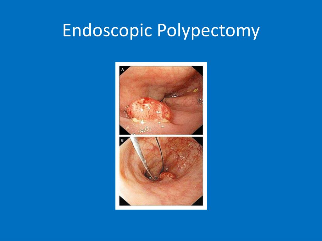 PPT Prevencion de Cancer de Colon PowerPoint Presentation, free