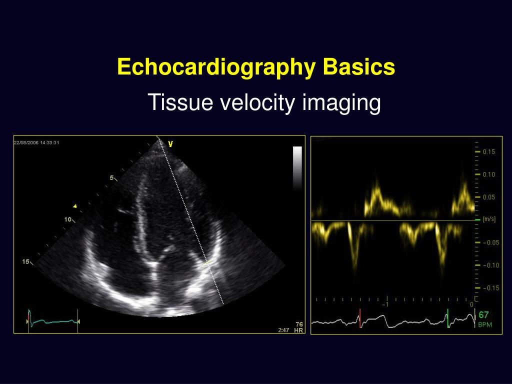 Ppt Basic Echocardiography Powerpoint Presentation Free Download
