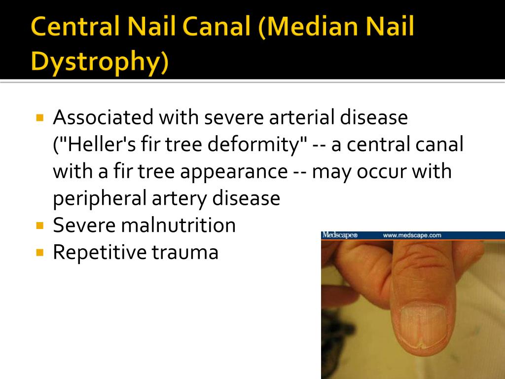 central nail canal median nail dystrophy l