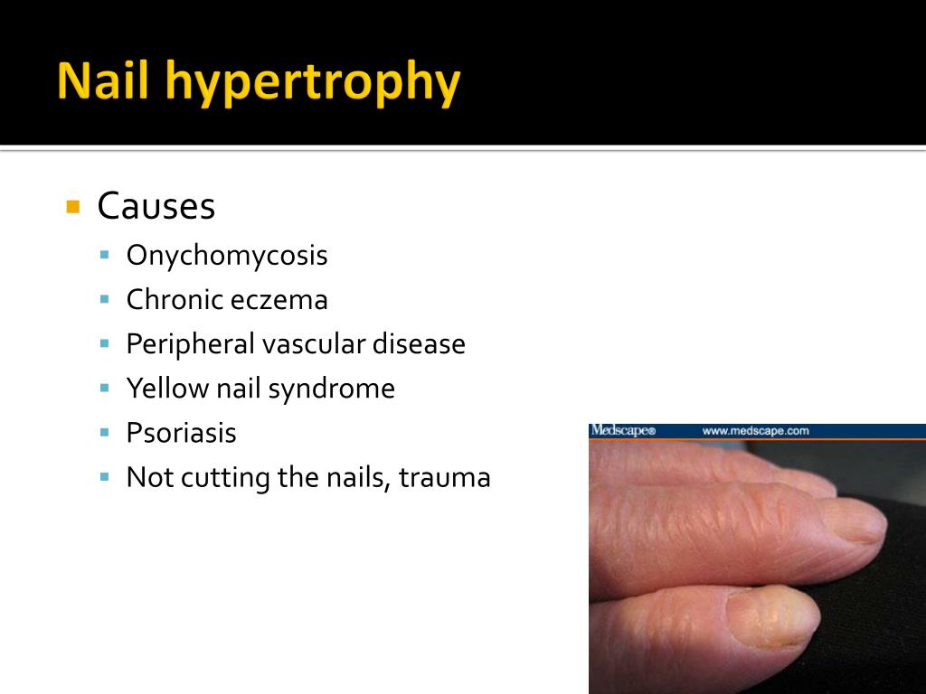 nail hypertrophy l