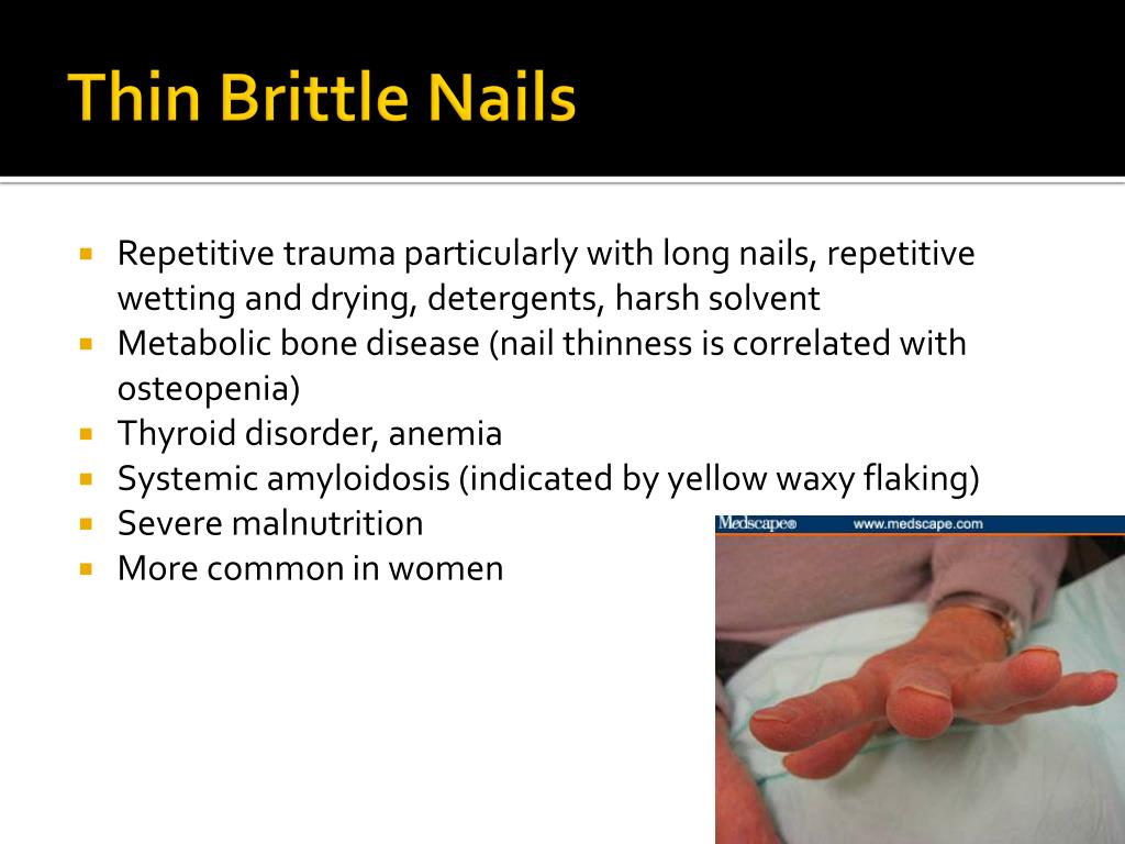 thin brittle nails l