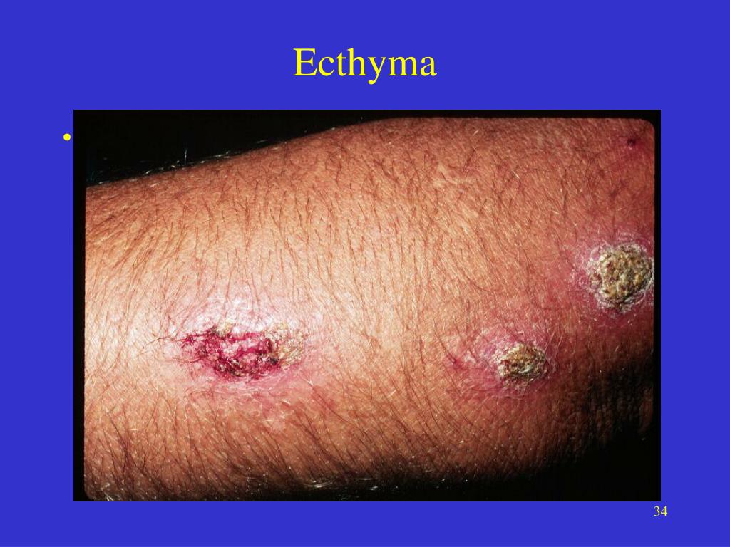 PPT Bacterial Infections Chapter 14 PowerPoint Presentation Free PPT Bacterial Infections Chapter 14 PowerPoint Presentation Free