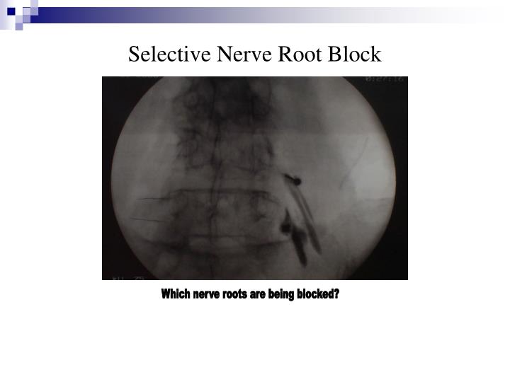 Lumbar Puncture Procedure Note Template