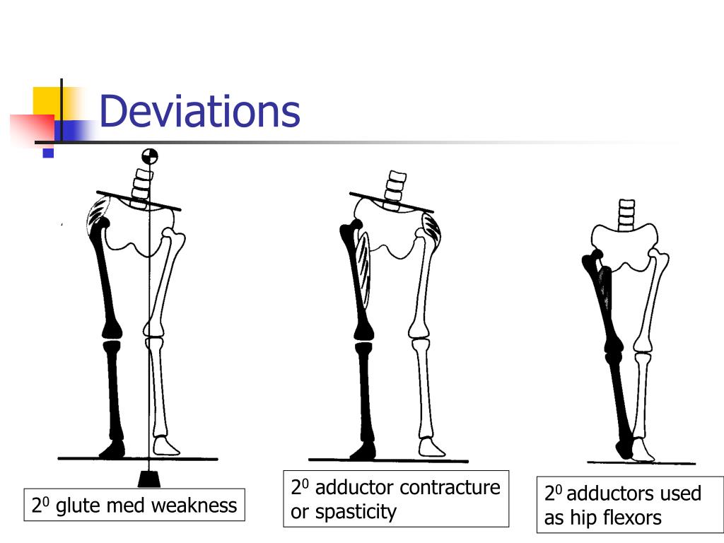 Hip Abductor Weakness After Total Hip Replacement At Angela Rich Blog