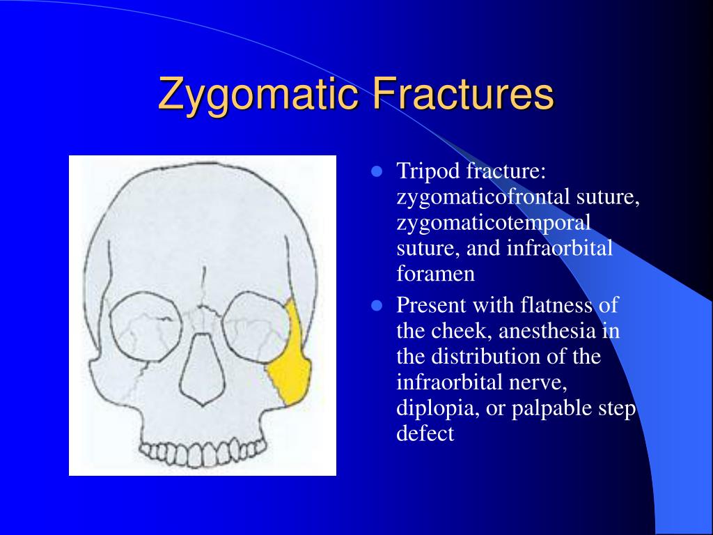 PPT - Facial Trauma PowerPoint Presentation, free download ...