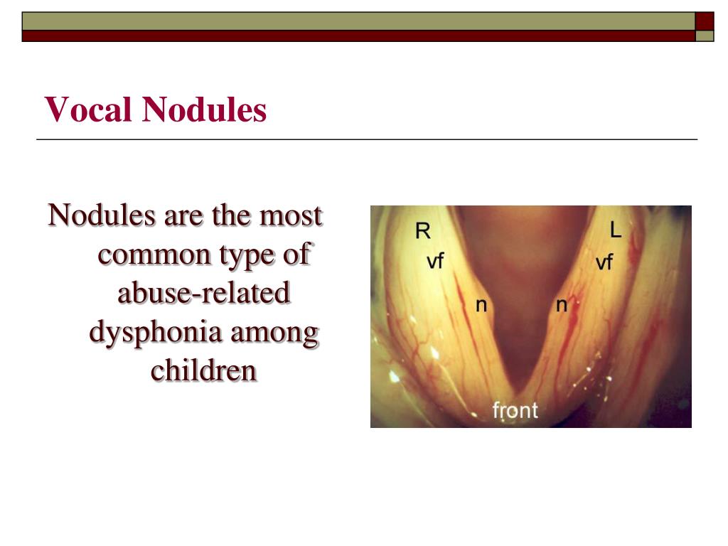 What Are Singer39s Nodules Vocal Nodules Isaac Namdar Md