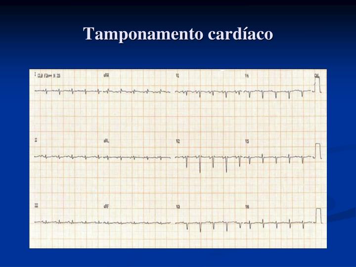 PPT - Caso Clínico: Pericardite Aguda na criança ...