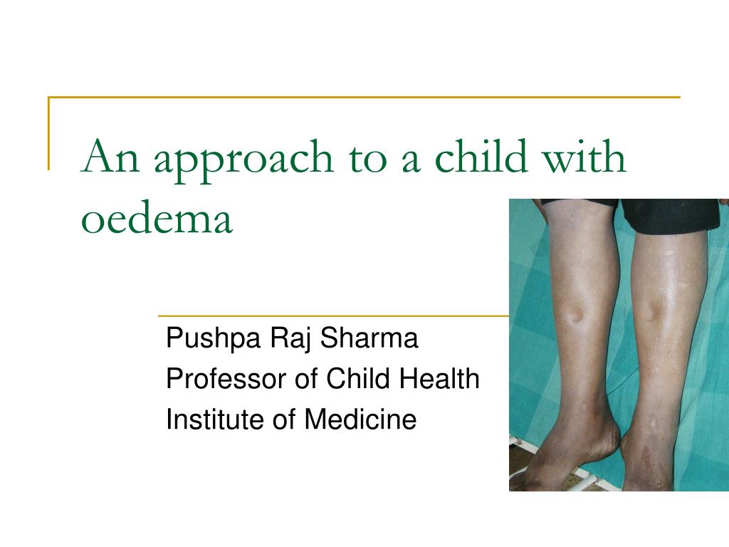 PPT An Approach To A Child With Oedema PowerPoint Presentation Free 