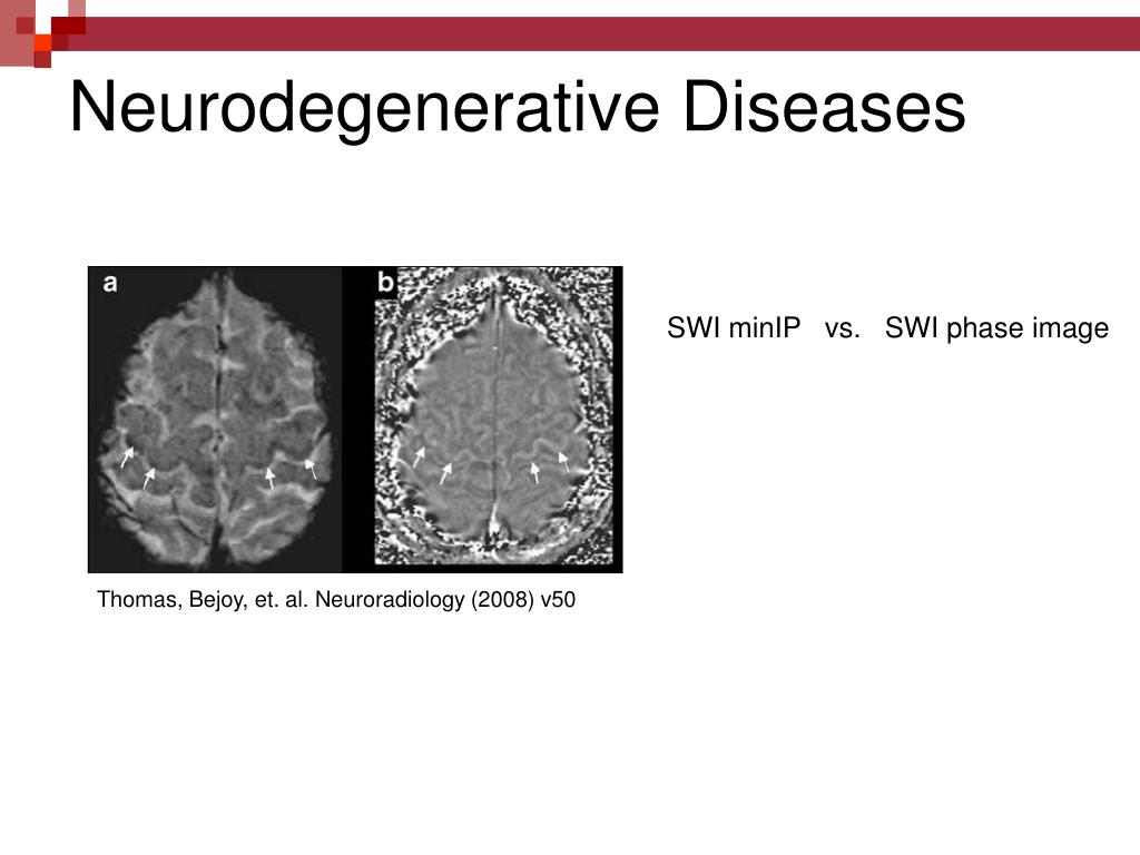 PPT - Susceptibility Weighted Imaging (SWI) PowerPoint Presentation