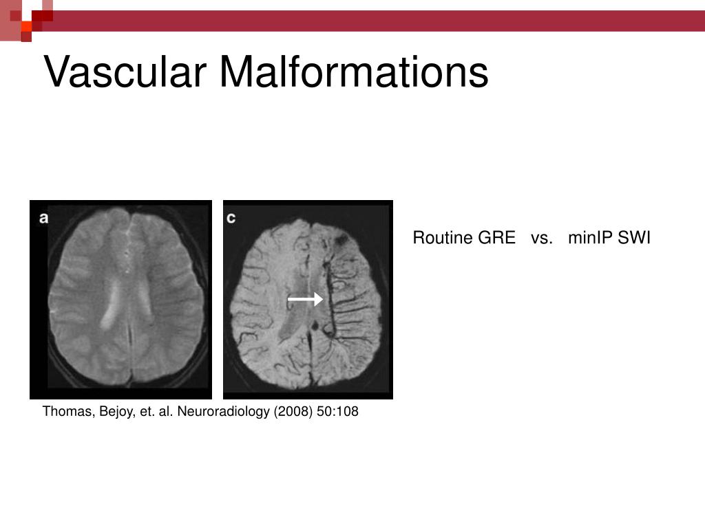PPT - Susceptibility Weighted Imaging (SWI) PowerPoint Presentation