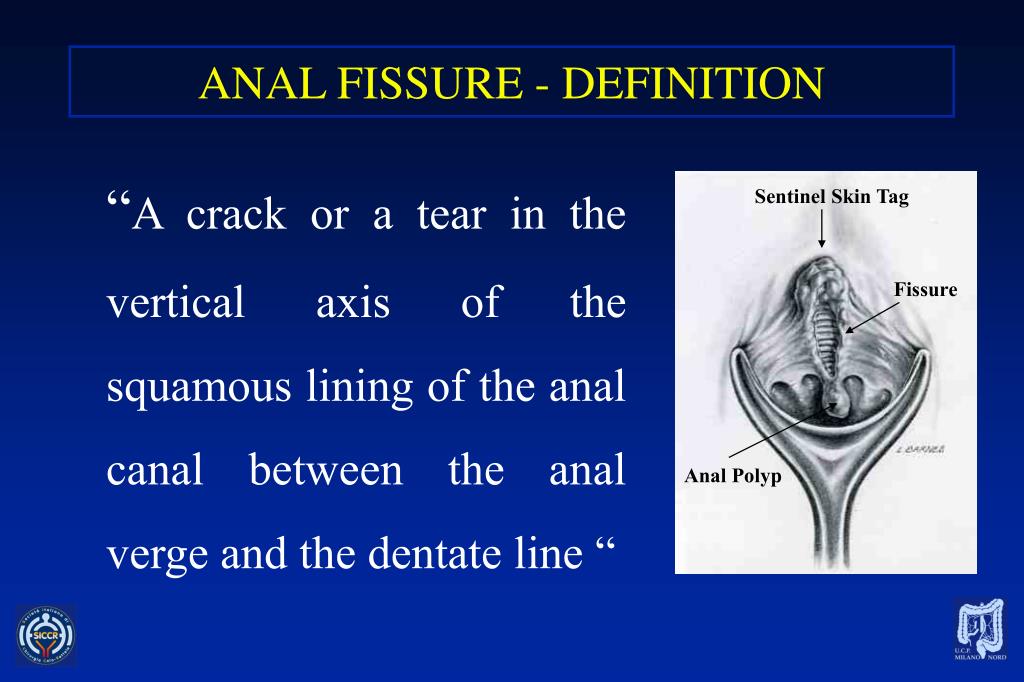 how to cure annal fissure