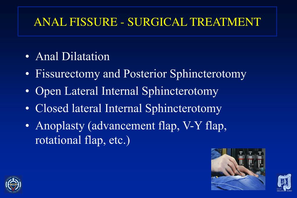 and fibromyalgia fissure Anal