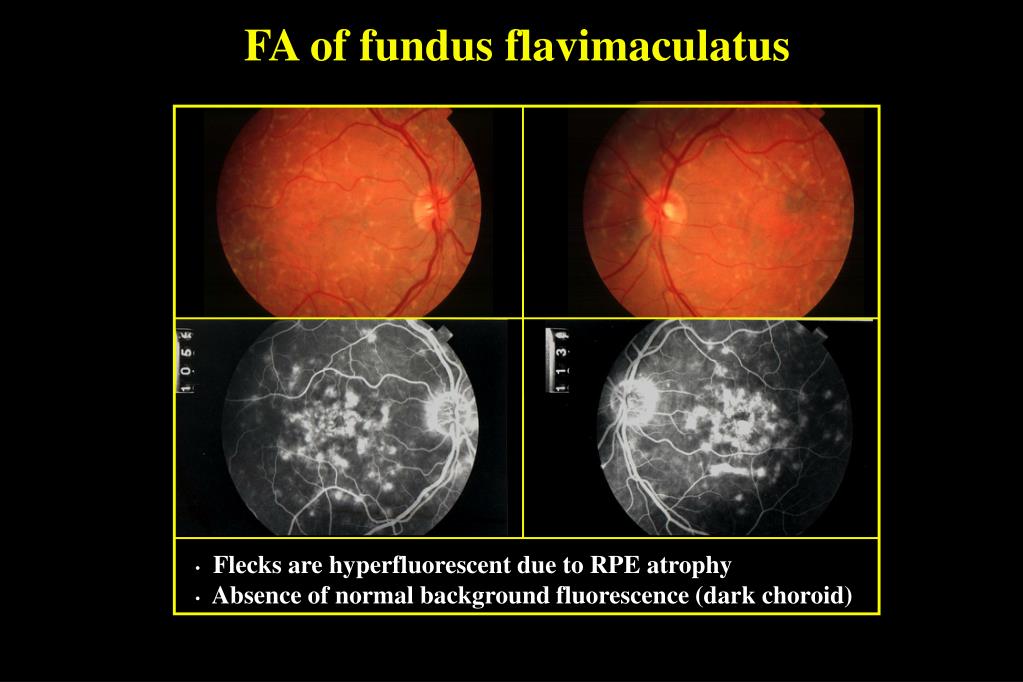 PPT HEREDITARY RETINAL DYSTROPHIES PowerPoint Presentation Free 