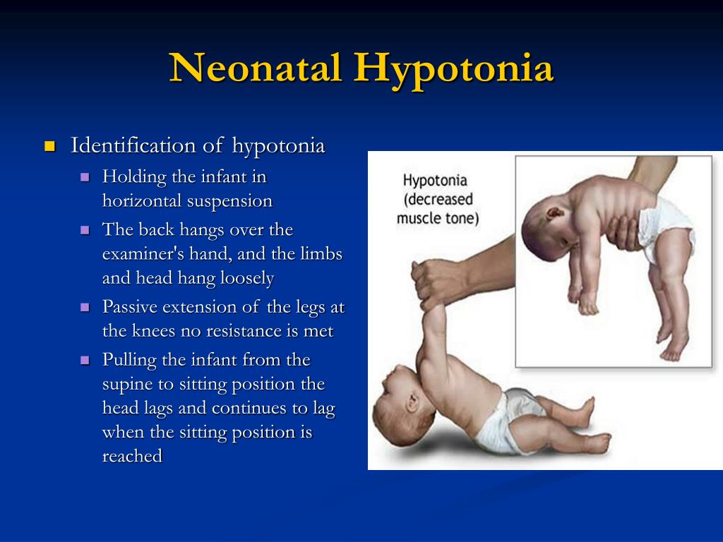 PPT - Neonatal Hypotonia Clinical Approach To Floppy Baby PowerPoint