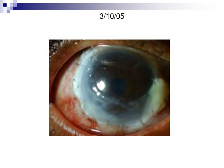 PPT - A case of Mooren's Ulcer PowerPoint Presentation 