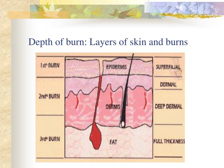 PPT - Integumentary: Burns PowerPoint Presentation - ID:337965