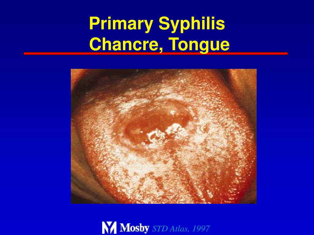 Syphilis Tongue Lesions
