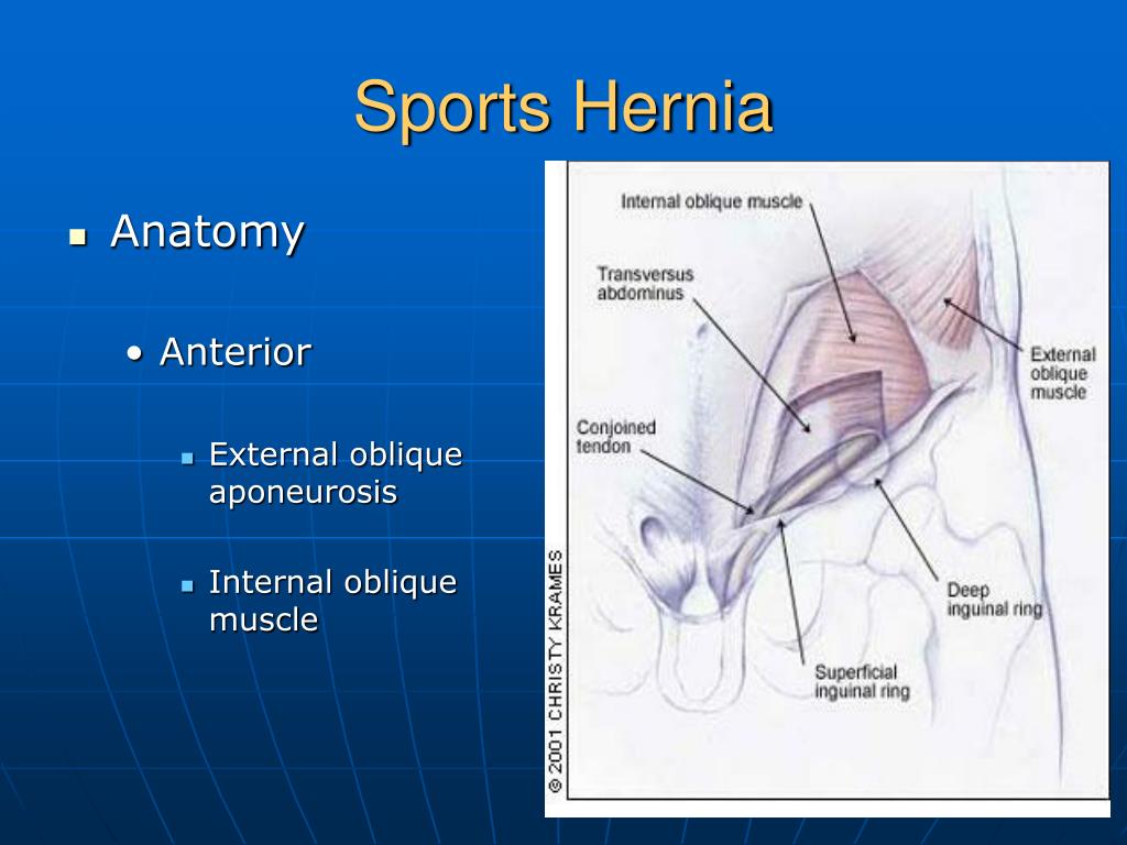 Ppt Sports Hernia Powerpoint Presentation Free Download Id339925