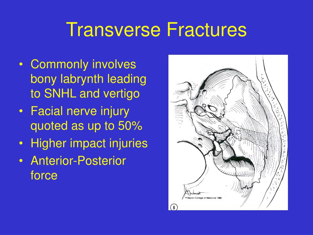 CSF leak as related to Bone Fracture - Pictures