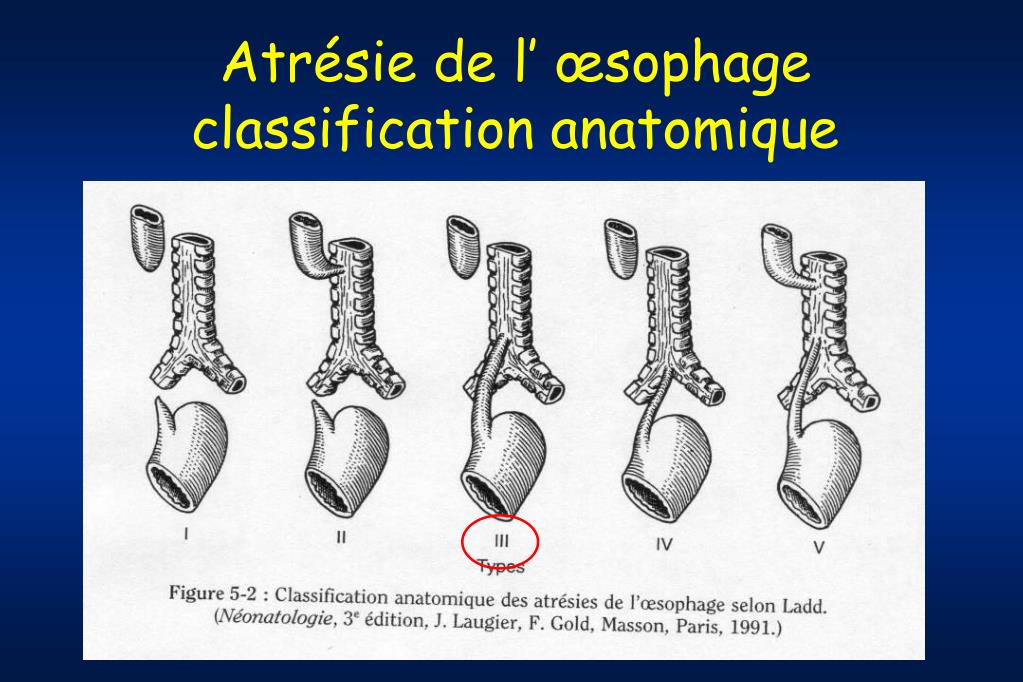 Atresie De Loesophage Esperance De Vie PPT - Pathologies chirurgicales néonatales PowerPoint Presentation