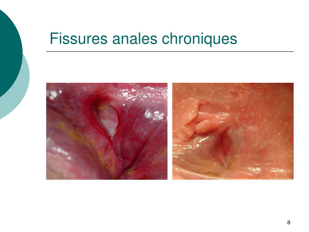 Managing anal fissures