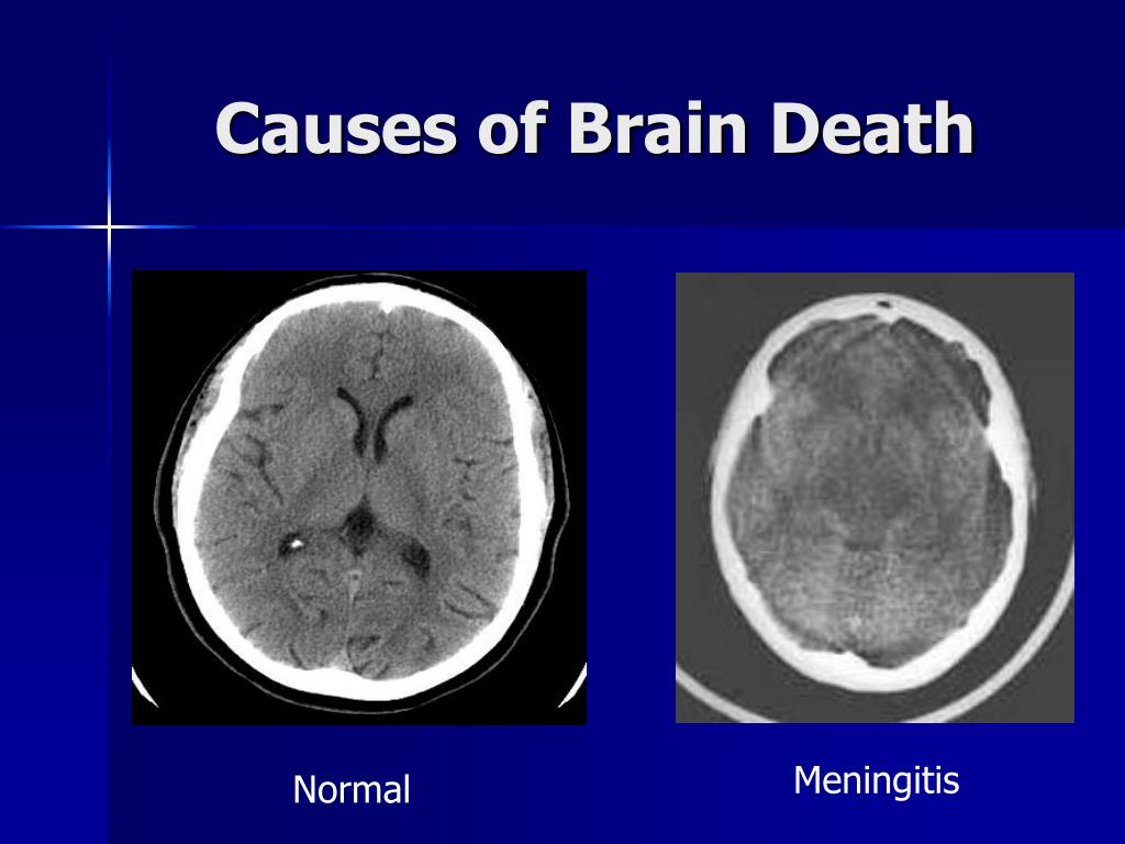 PPT - Brain Death Anatomy and Physiology PowerPoint Presentation, free