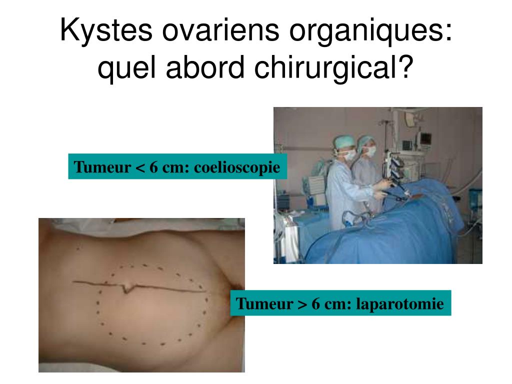 PPT - Chirurgie des tumeurs de l'ovaire: comment, quand, (par) qui ...