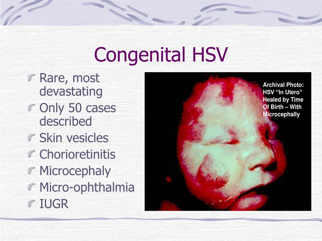 congenital hsv presentation