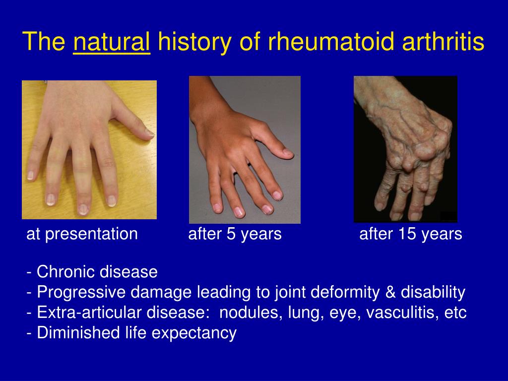 typical presentation of rheumatoid arthritis