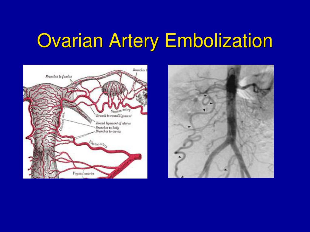ppt interventional radiology in the treatment of uterine artery embolization