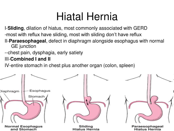 PPT - GERD/Barrett's Esophagus, Dysphagia, Hiatal Hernia, and ...